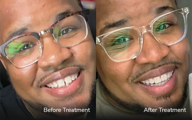 before after invisalign tijuana cost 03