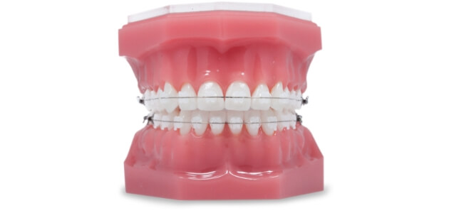 ceramic braces tijuana