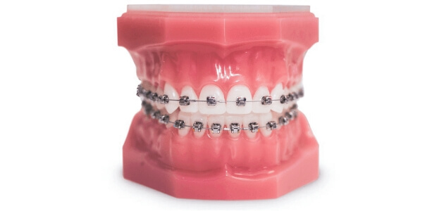 metal braces tijuana